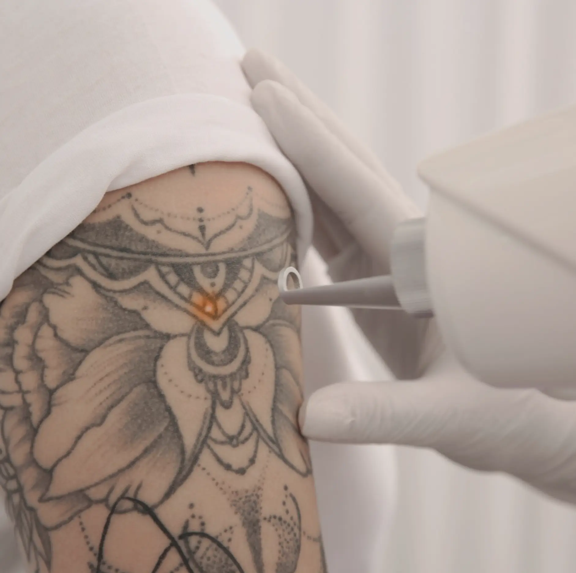laser tattoo removal course cost