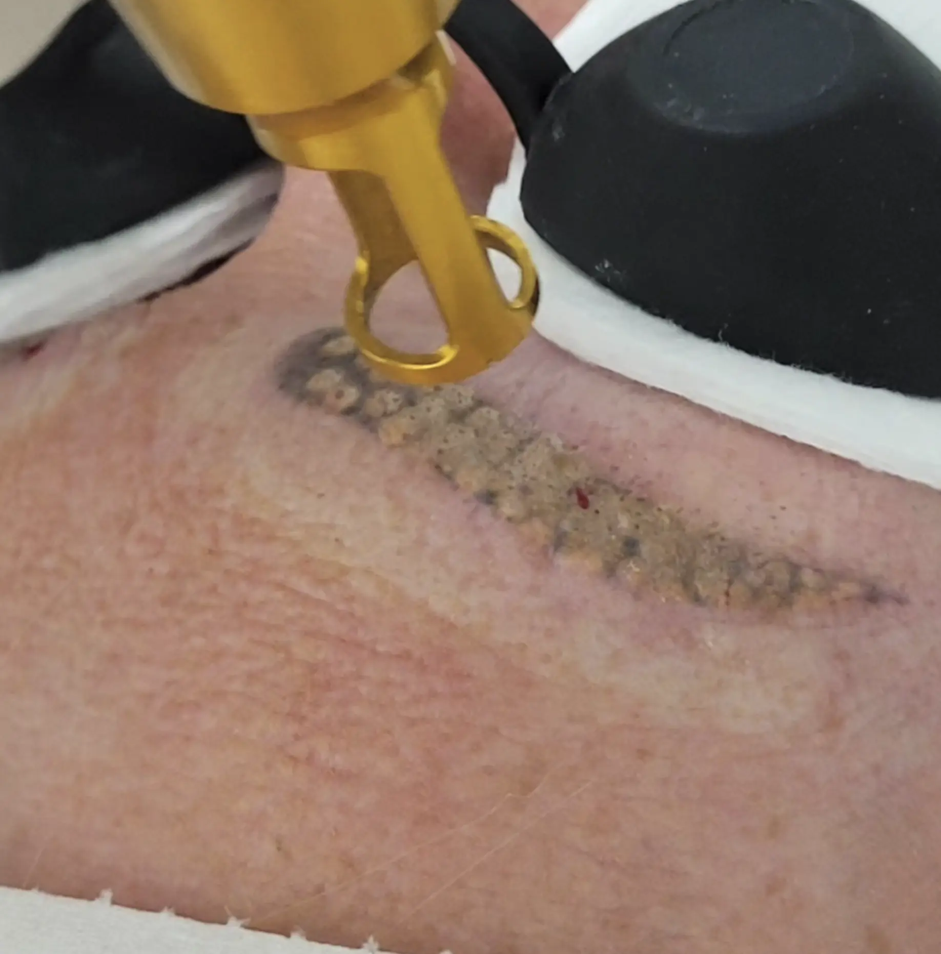 laser tattoo removal course online