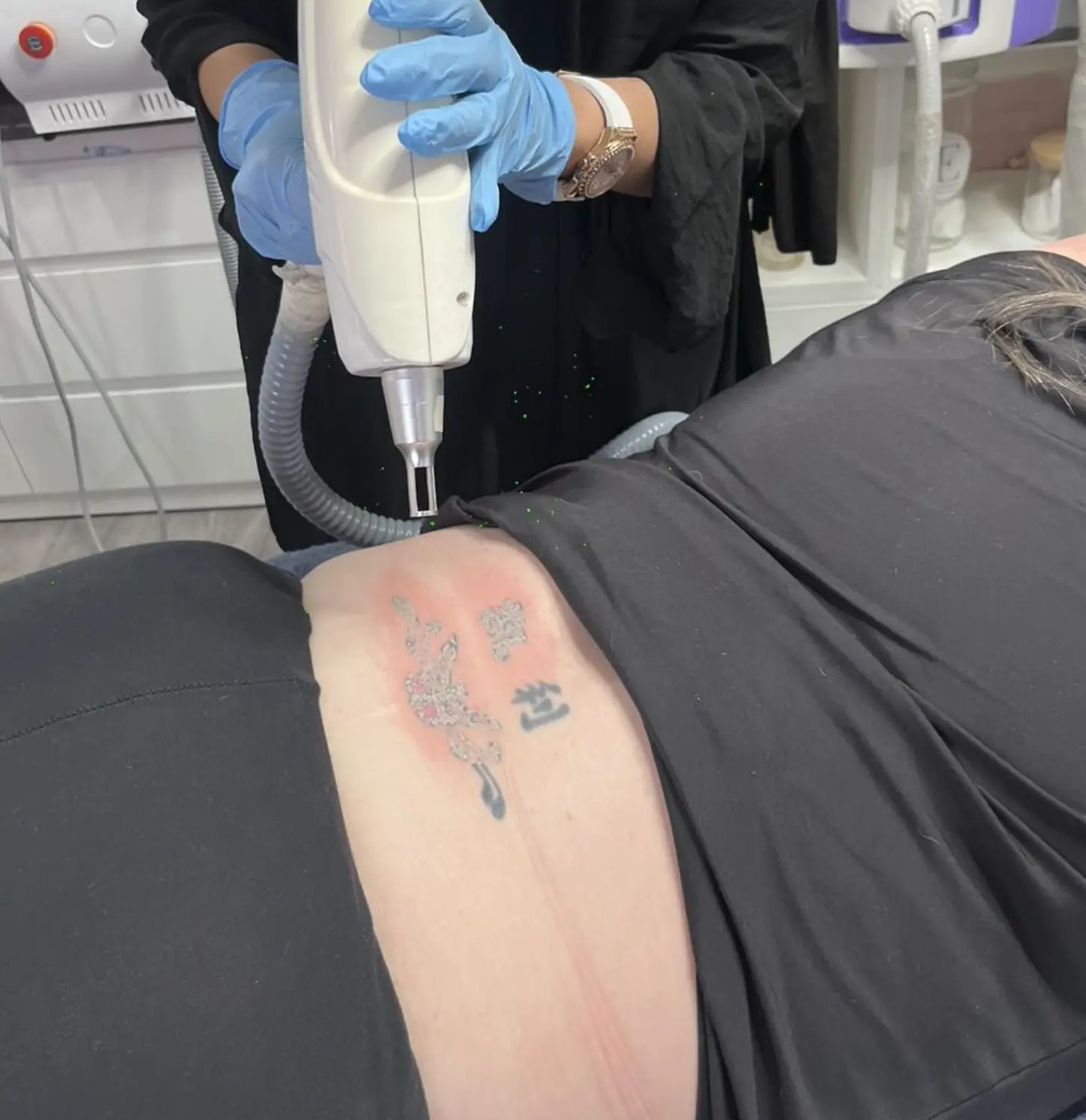 tattoo removal course near me